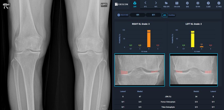 크레스콤, 국내 최초 무릎 관절염 심각도 정량화 자동분석 인공지능 소프트웨어 ‘MediAI-OA’ 의료기기 제조허가 취득