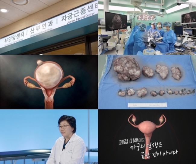 명의 937회 갱년기 이후, 내 자궁은 안전한가?